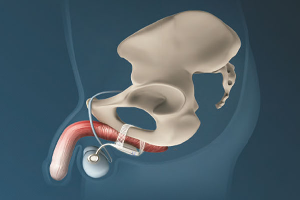 Il trattamento con ATOMS dell’Incontinenza Urinaria maschile dopo chirurgia prostatica – 29-30 Ottobre 2014